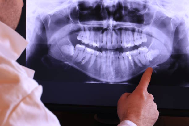 Best Emergency Treatment for Dental Infections or Abscesses in Bon Secour, AL