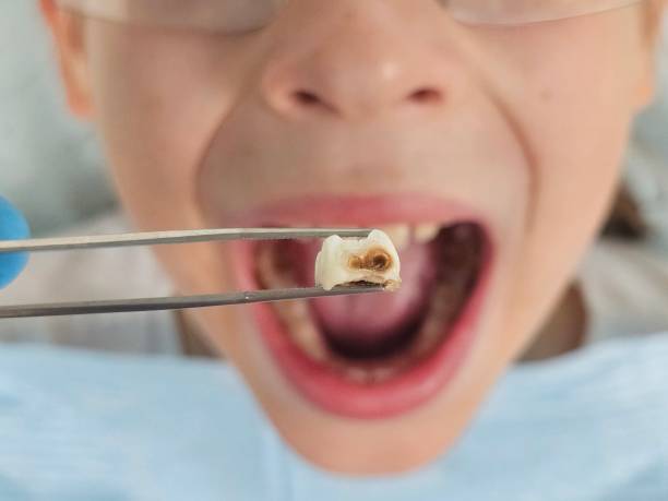 Best Emergency Dental Care for Broken or Chipped Teeth in Bon Secour, AL